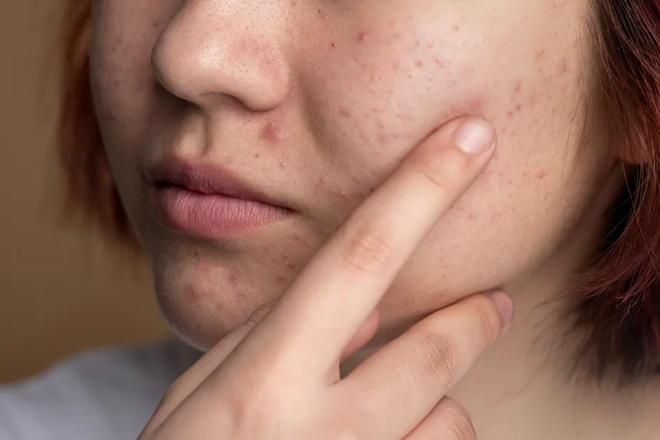 Blackheads and How Treatment Addresses Them Properly
