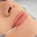 Lip Enhancement Procedure