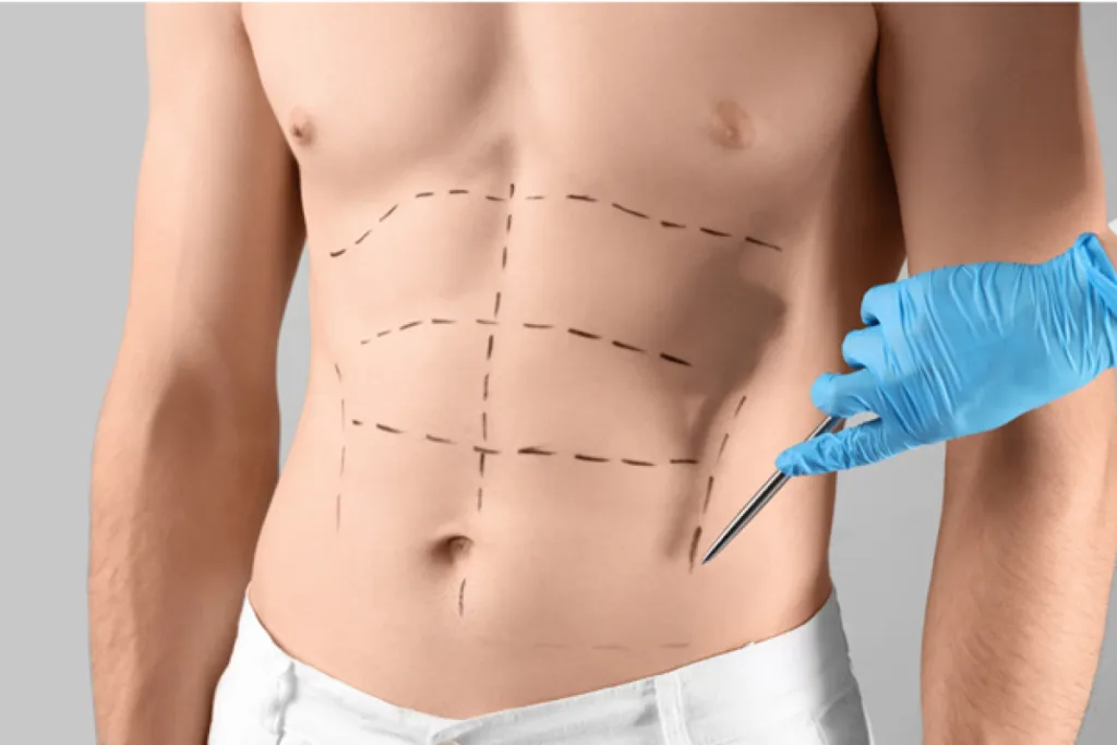 Mini Tummy Tuck